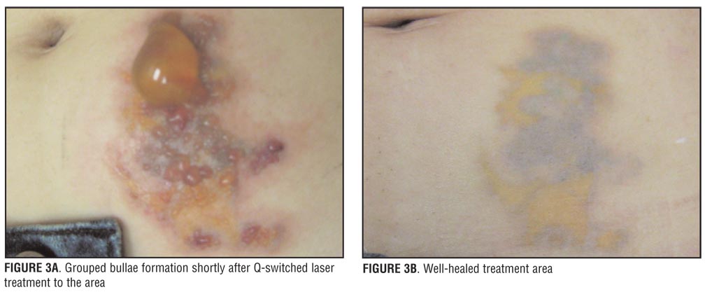 Treatment of Large Bulla Formation after Tattoo Removal ...