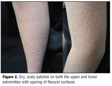 Lower Legs Very Scaly Skin 42