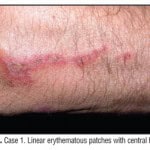 Paederus Dermatitis: An Outbreak on a Medical Mission Boat in the Amazon