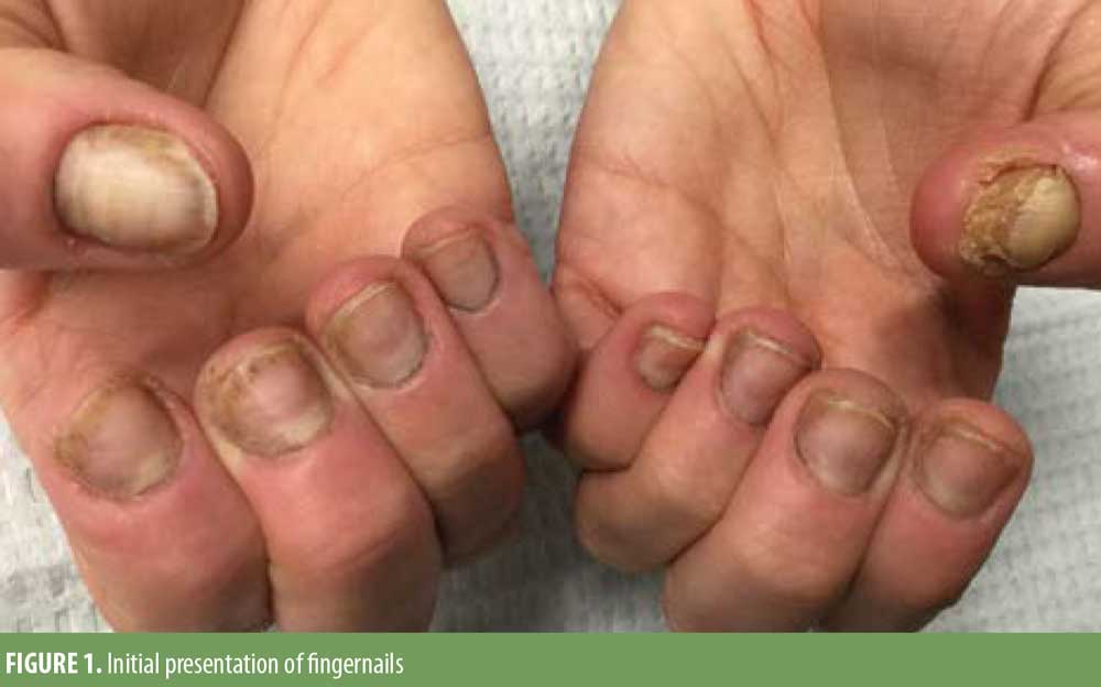 Psoriasiform Onychodystrophy Induced by Photobonded Acrylic Nails – JCAD |  The Journal of Clinical and Aesthetic Dermatology