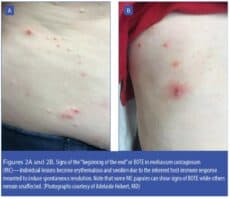 Molocous Rash Comprehensive Management of Molluscum Contagiosum: Assessment of ...