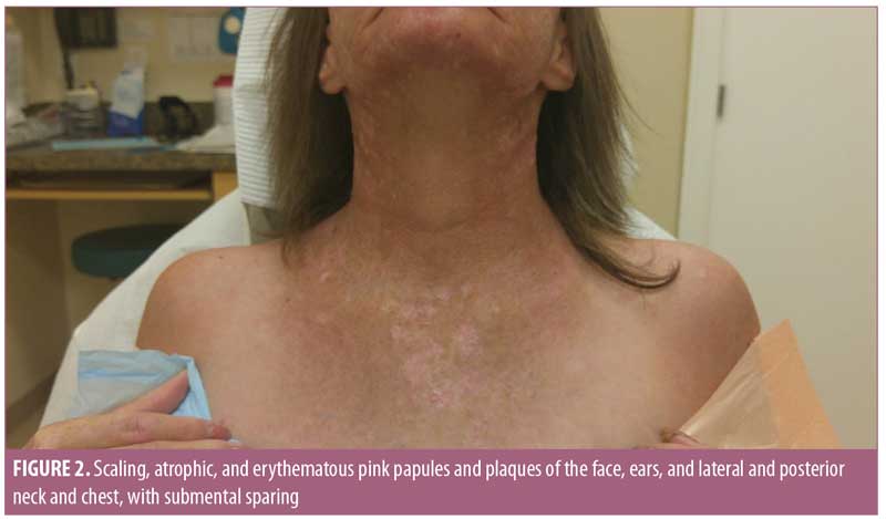 Lupus Erythematosus Lichen Planus Overlap Syndrome Mimicking