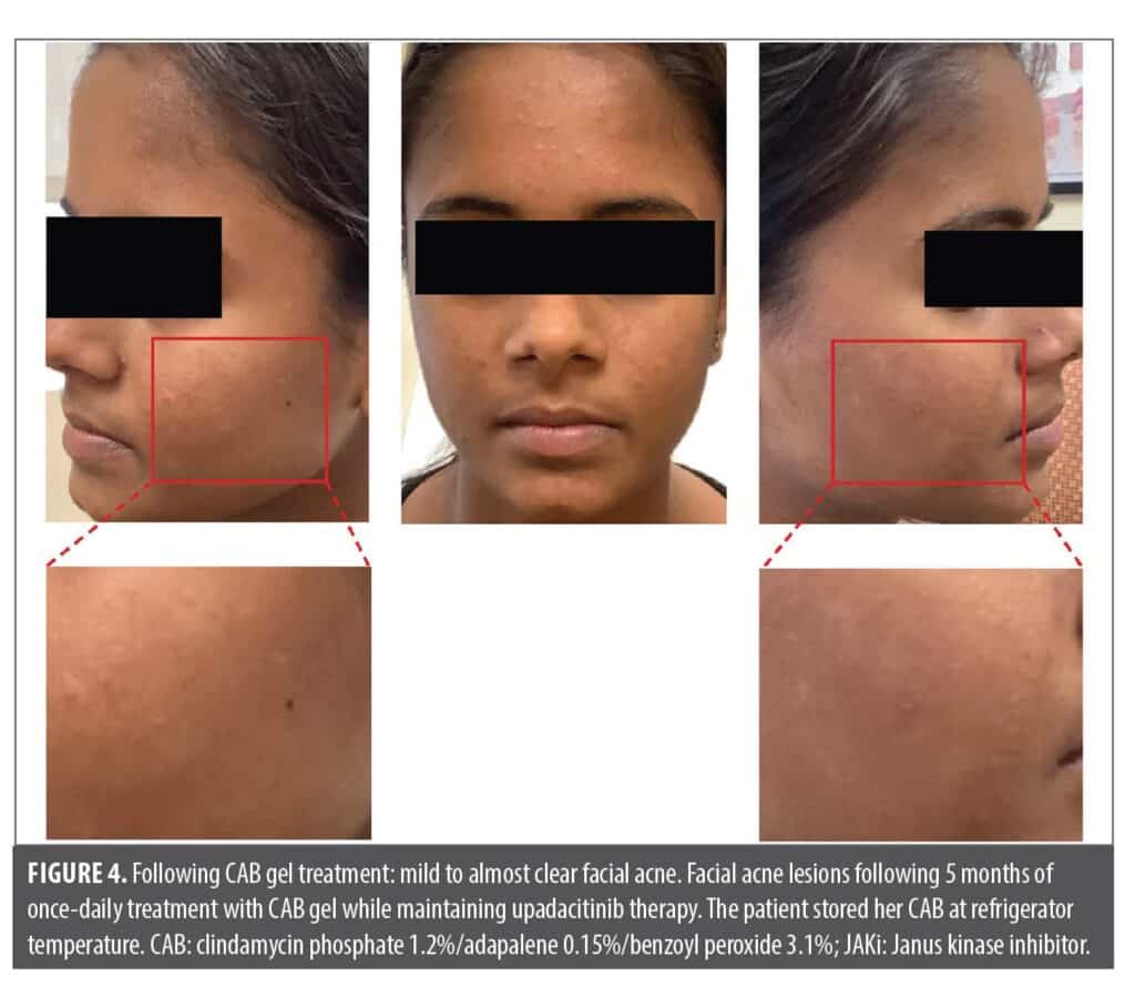Clindamycin Phosphate 1.2%/Adapalene 0.15%/Benzoyl Peroxide 3.1% to ...