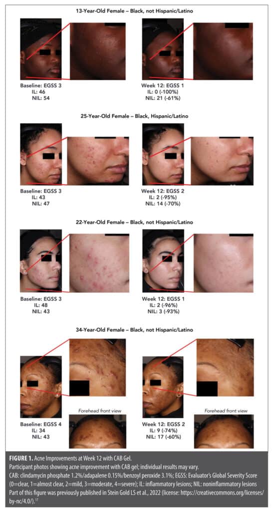 Delayed Clindamycin Rash Efficacy and Safety of Fixed-dose Clindamycin Phosphate 1.2%/Adapalene ...