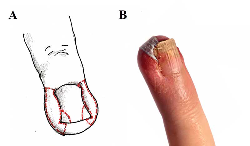 Letter to the Editor: How to Manage a Real Clinical Rarity: Pluri-recurrent  Ingrown Fingernail – JCAD | The Journal of Clinical and Aesthetic  Dermatology