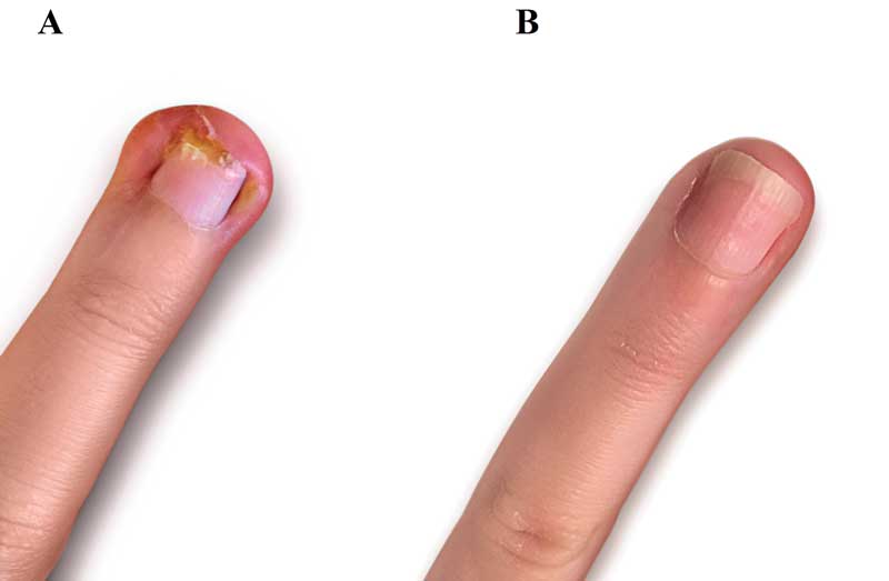 Surgical Treatment of Ingrown Toe Nail: The Monaldi Technique, a New Simple  Proposal | Semantic Scholar
