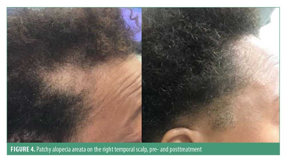 Bi-temporal Scalp Hair Loss: Differential Diagnosis of Nonscarring and  Scarring Conditions – JCAD | The Journal of Clinical and Aesthetic  Dermatology