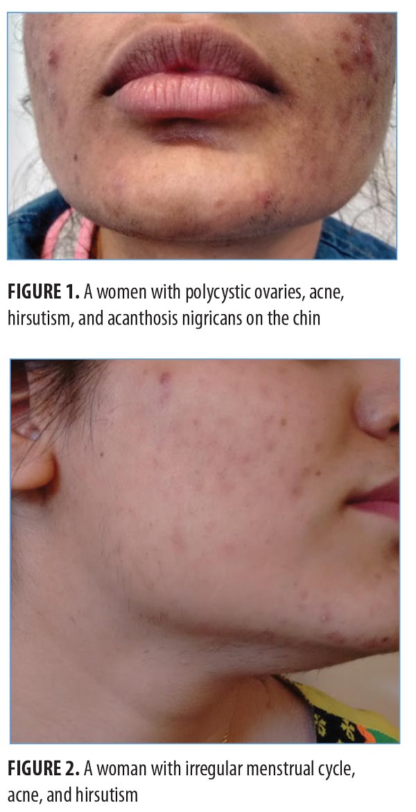 polycystic ovarian syndrome acne