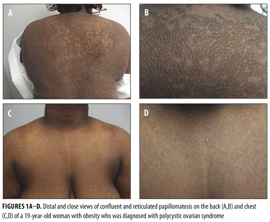 Confluent and reticulated papillomatosis vs acanthosis nigricans - Confluent papillomatosis define