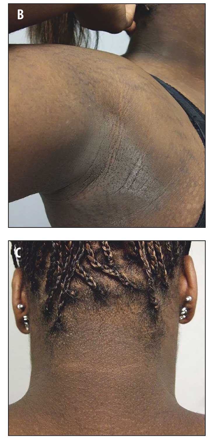Confluent and reticulated papillomatosis acanthosis nigricans