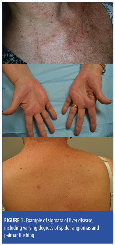 Spider Telangiectases And Palmar Erythema As Harbingers Of Structural Liver Changes In Three Breast Cancer Patients On Ado Trastuzumab Emtansine Jcad The Journal Of Clinical And Aesthetic Dermatology