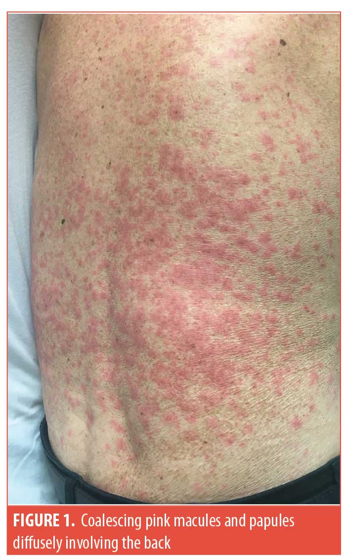 Drug Reaction Skin Rash