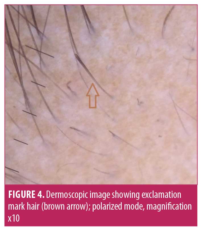 The Role of Dermoscopy in Severity Assessment of Alopecia Areata: A  Tertiary Care Center Study – JCAD | The Journal of Clinical and Aesthetic  Dermatology