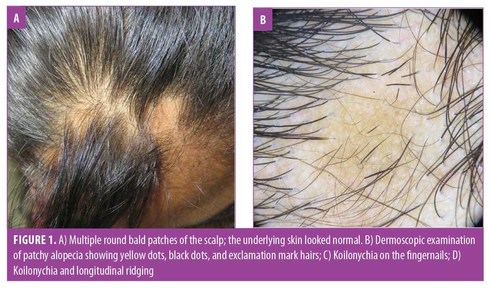 Koilonychia in a Patient with Alopecia Areata – JCAD | The Journal of  Clinical and Aesthetic Dermatology