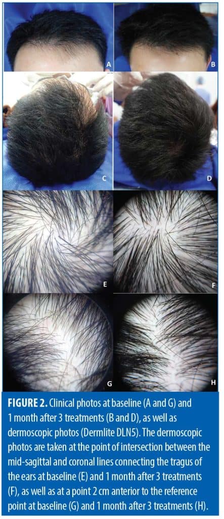 novel-application-of-1064-nm-picosecond-nd-yag-laser-for-male