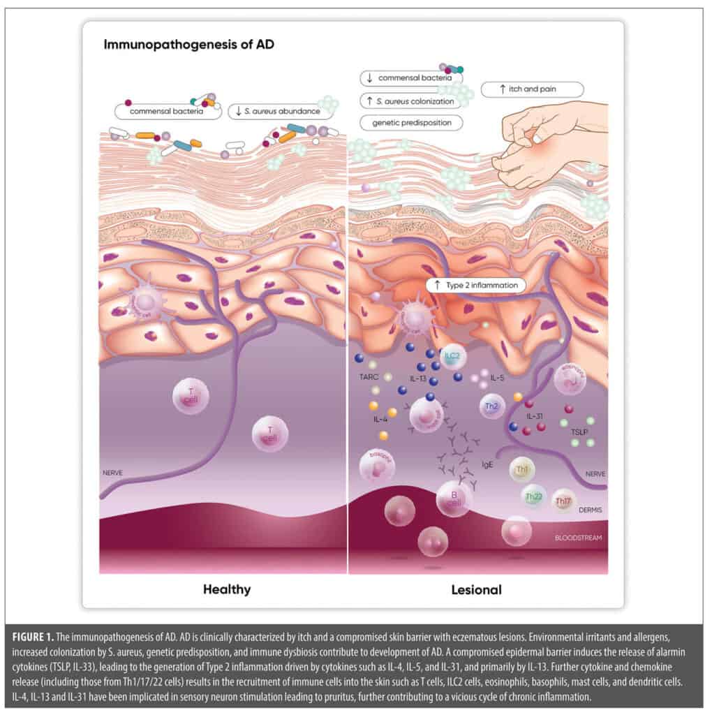 An Overview of Atopic Dermatitis Disease Burden, Pathogenesis, and the ...