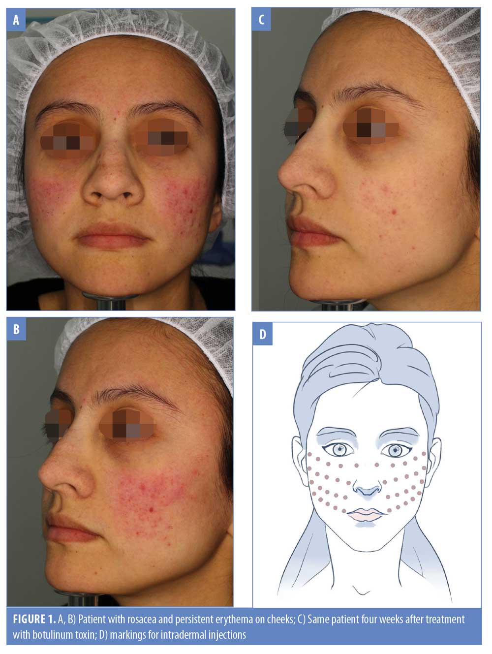 Luftpost Isse Ligegyldighed Botulinum Toxin: An Effective Treatment for Flushing and Persistent  Erythema in Rosacea – JCAD | The Journal of Clinical and Aesthetic  Dermatology