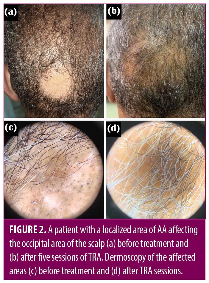 Rageh_Figure2 | JCAD | The Journal of Clinical and Aesthetic Dermatology