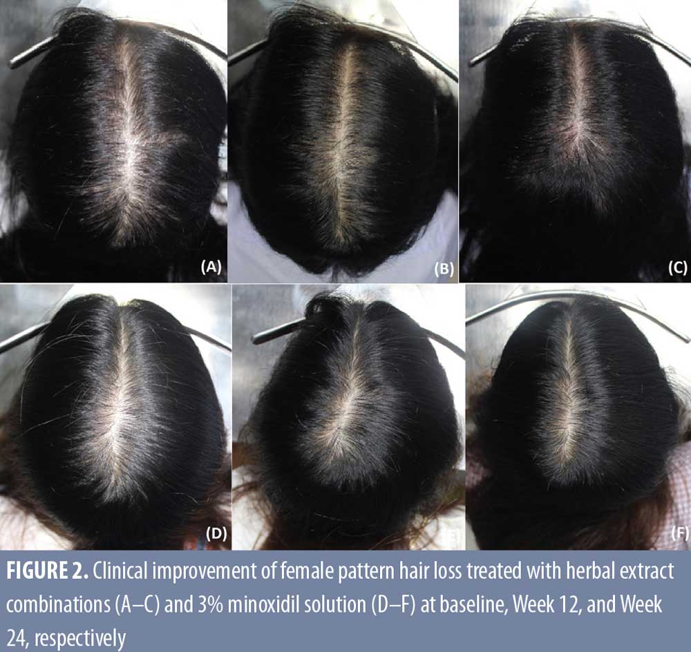 lighed elasticitet stressende An Herbal Extract Combination (Biochanin A, Acetyl tetrapeptide-3, and  Ginseng Extracts) versus 3% Minoxidil Solution for the Treatment of  Androgenetic Alopecia: A 24-week, Prospective, Randomized, Triple-blind,  Controlled Trial – JCAD | The
