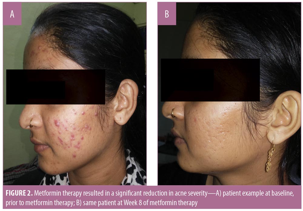 can stopping metformin cause acne