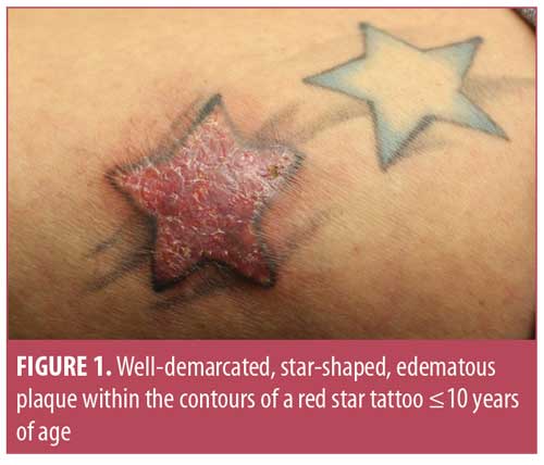 A New Era For Tattoos, with New Potential Complications – JCAD | The  Journal of Clinical and Aesthetic Dermatology