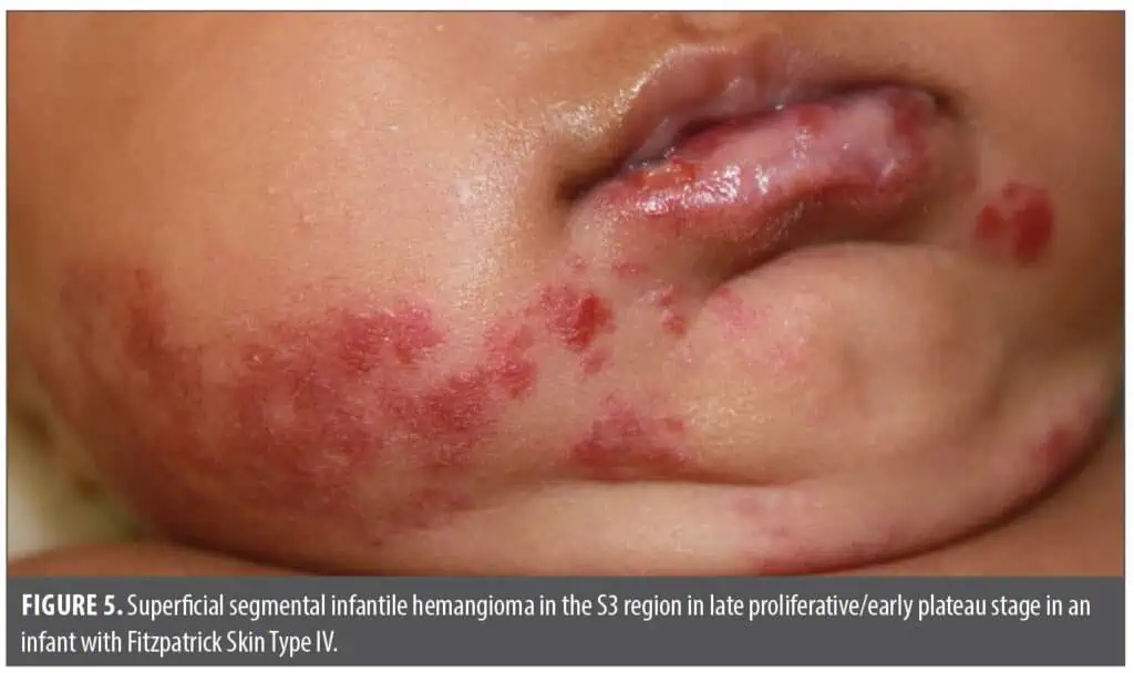 Skin Color Recktangular Shape Diagnosis of Vascular Anomalies in Patients with Skin of Color | JCAD ...