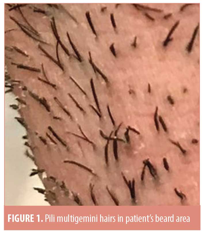 Of out why one hairs follicle grow do multiple Does Pulling