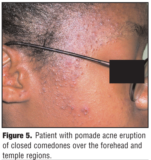 A Review Of Acne In Ethnic Skin Pathogenesis Clinical